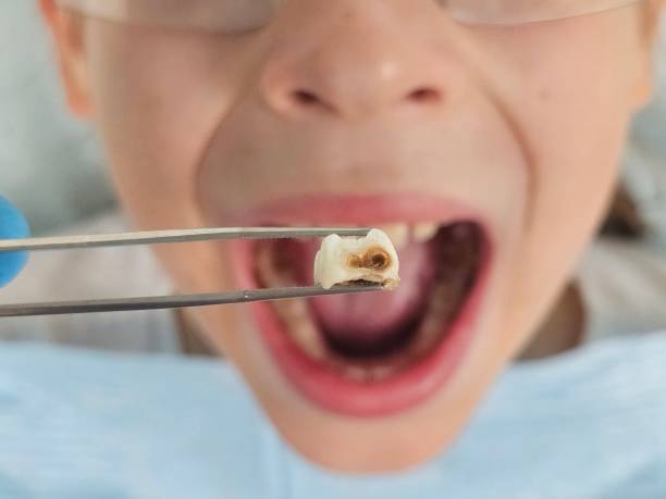 Best Emergency Wisdom Tooth Extraction in Manhattan, IL